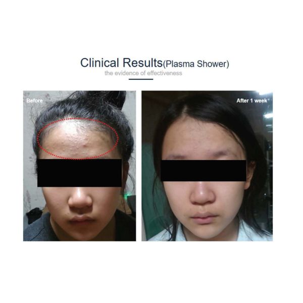 TDDS Antibacterial Acne Scar Treatment / Facial Beauty Machine With 2 Handles