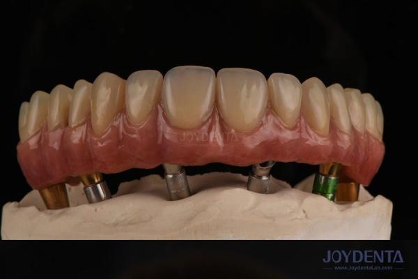 Ivoclar Implant Ball Attachments Removable Dental Implant Material For Oral Hygiene