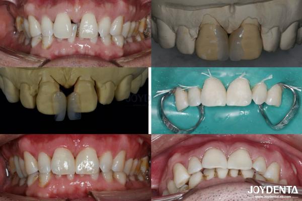 Ceramic For Natural Aesthetics Dental Veneers Stain Resistance Maintains Brightness Strong Bond With Tooth Enamel For Secure Fit