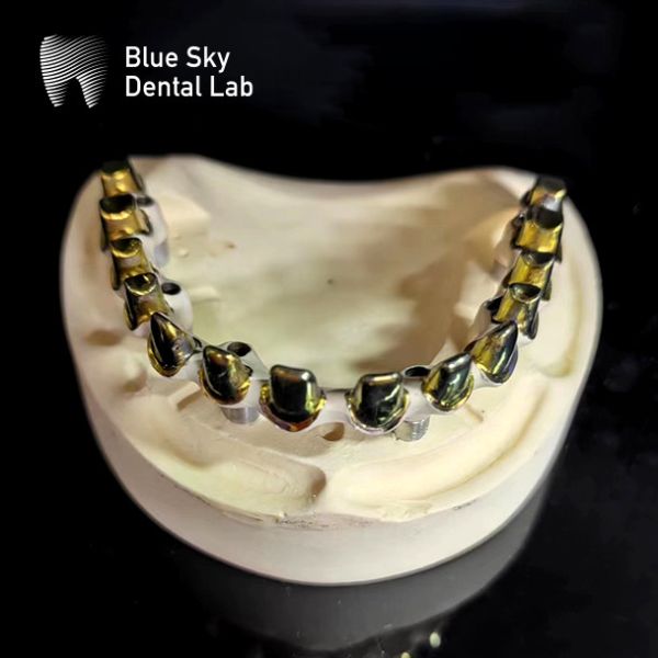 Шрубы удержаны MUA опоры Имплантантные корпуса Циркониевые короны Многослойный розовый фарфор с легким ремонтом