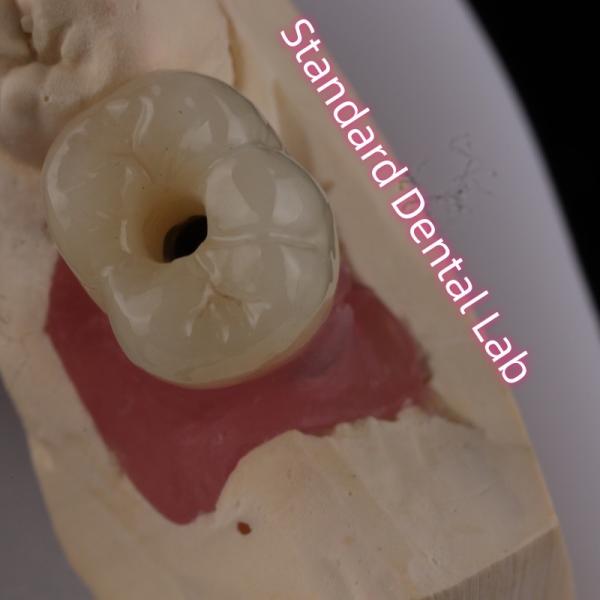 Implantation postérieure couronne bruxier vis en zirconium solide retenue