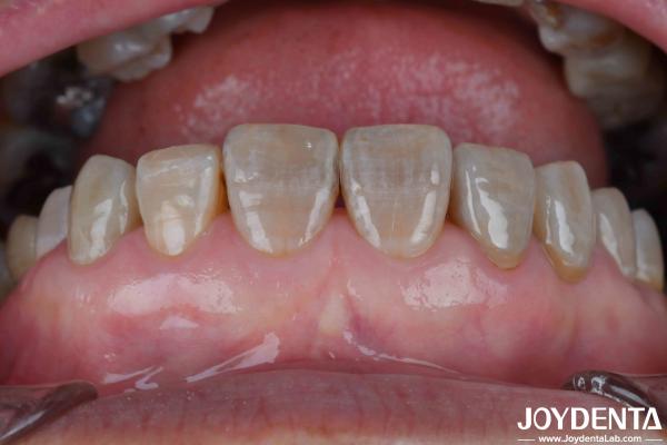 Lightweight Dental Zirconia For Optimal Patient Experience Natural Color Transitions And Biocompatibility Guaranteed