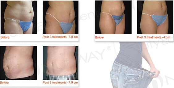 Manufactory supply newest HIFU slimming machine for sale