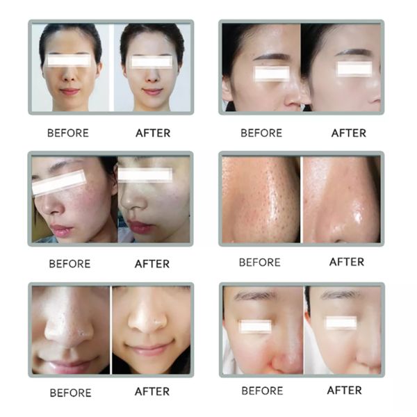 Get a Clean and Glowing Face with Our CE Certified Oxygen Jet Peel Facial Machine