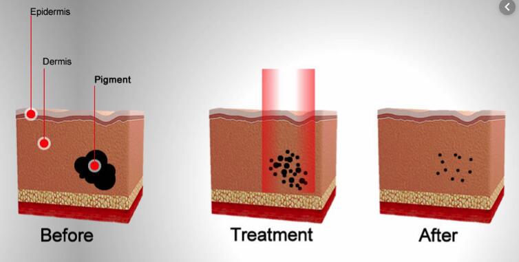 Picosecond Laser Machine Featuring Wind Spray Cooling Nozzle for Continuous Surface Cooling and Improved Patient Comfort