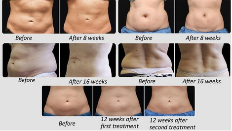 Женское портативное Cryolipolysis уменьшая машину ультракрасное 700nm для уменьшения целлюлита
