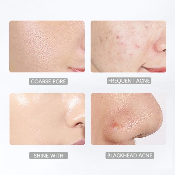 Tinta ácida salicílica de hidratación 100ML para el ODM aceitoso del OEM de la piel del acné