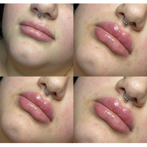 Вводимая впрыска Juvederms заполнителя заполнитель ультра 3 HA дермальный для тома губы