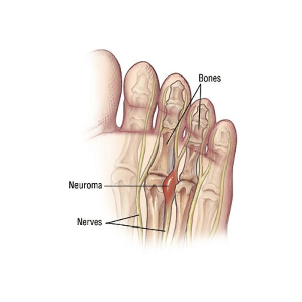 1064nm 10W Laser Surgery Equipment Berylas Laser Toenail Fungus Removal