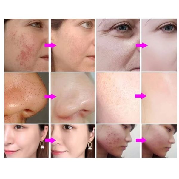 Hydra Peeling Hydra Small Bubble Water Hydro Aqua Facial H2O2 Hydra Machine (Гидра для очистки лица)