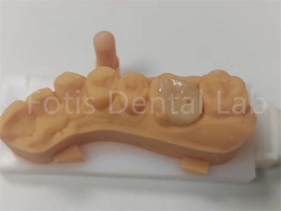 Dental Restorations Ceramic Inlay And Onlay For Long Lasting