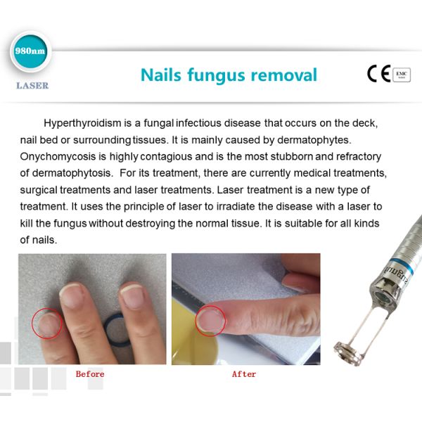 spider veins vascular vein removal nail fungus 980nm diode laser therapy machine for toe nail fungus treatment