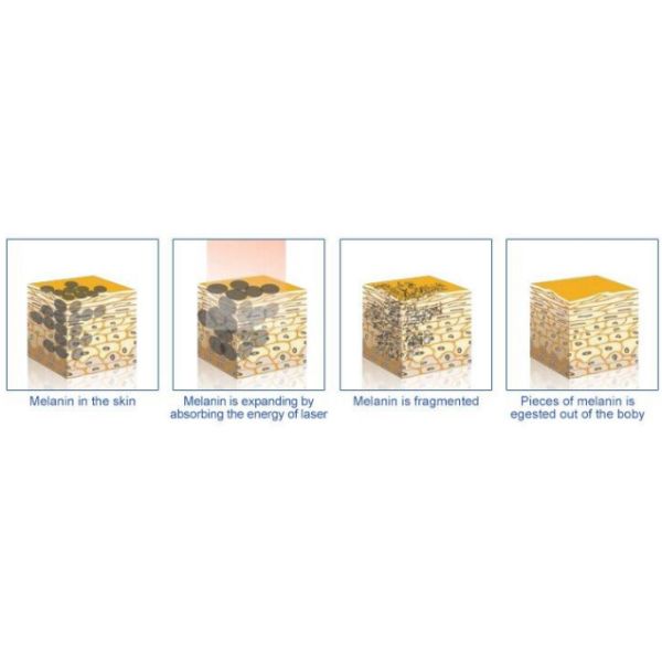 532/1064nm Portable Q Switch  Nd Yag Laser Tattoo Removal Beauty machine with Cart and Carbon skin rejuvenation tip