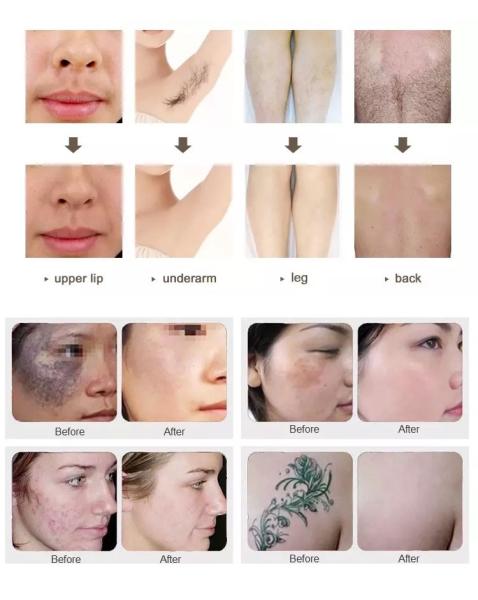 Máquina comutada Q médica do laser do Nd Yag, máquina da remoção da tatuagem do laser da beleza