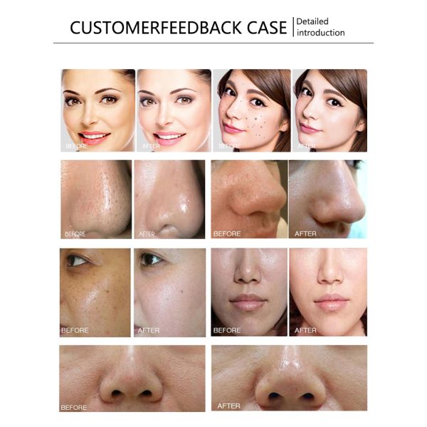 Multifuncional 10 en 1 cuidado facial piel Hidratante hidra oxígeno máscara jet peel piel cuidado facial máquina