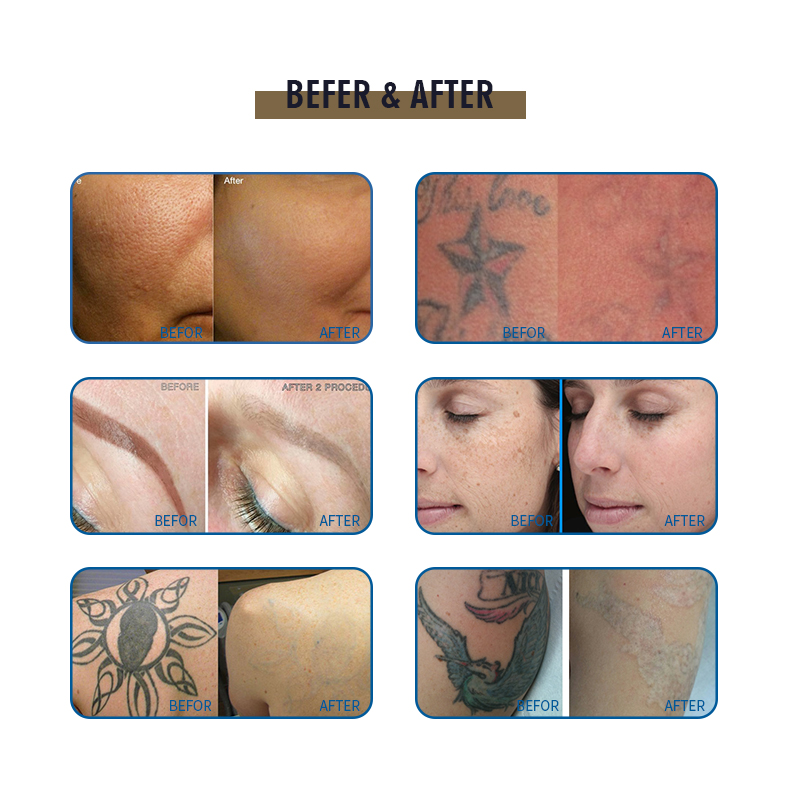 Vertical 1064nm / 532nm Nd Yag Laser Tattoo Removal Machine Skin Treatment