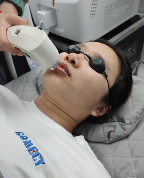 Máquina portátil de redução de pelos da pele para lesões vasculares e remoção de manchas faciais