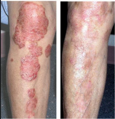 UVB Phototherapy Light Therapy Treatment For Psoriasis