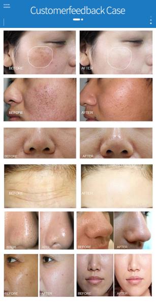 7 In 1 Professional Water Oxygen Jet Peel Machine Facial Deep Cleaning
