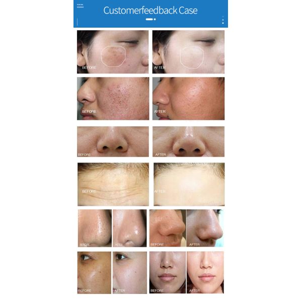 Skin Cleaning Hydrafacial Beauty Machine 7 In 1  Diamond Oxygen Jet Peel Machine