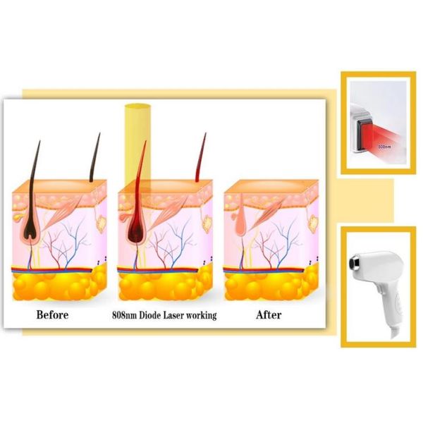 808nm Diode Laser Hair Removal Machine Portable For All Skins Fast Painless