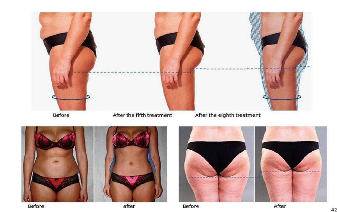 1 - 100Hz EMS RF máquina estacionaria EMS máquina de construcción muscular 220V