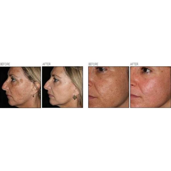 Hot sale scar removal stretch mark removal 10600nm Fractional Co2 laser machine