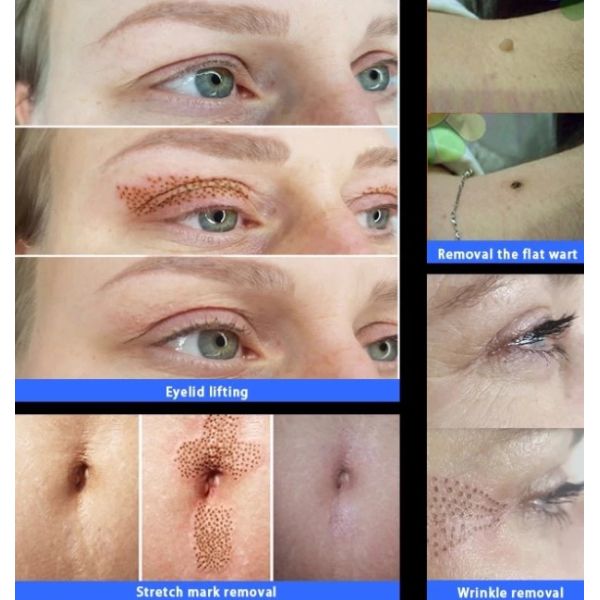 100%Korea Fibroblast plasma pen jet plasmalift Face Eyelid Lift plamere premium plaxpot plamon plaxel+ plasma pen