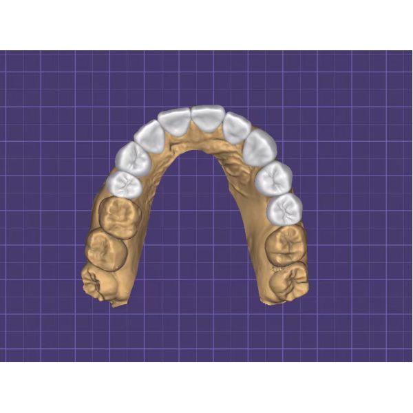 Precision Fit Digital Wax Up Dental Study Model with Durable and Biocompatible 3D Printed Design