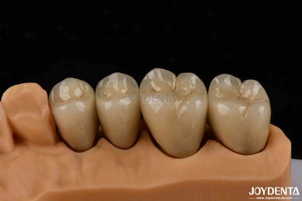 Premium Gold and Palladium Alloy Dental Crowns for Enhanced Durability