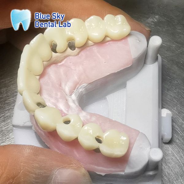 Cuerpo de implantes dentales de zirconia personalizado
