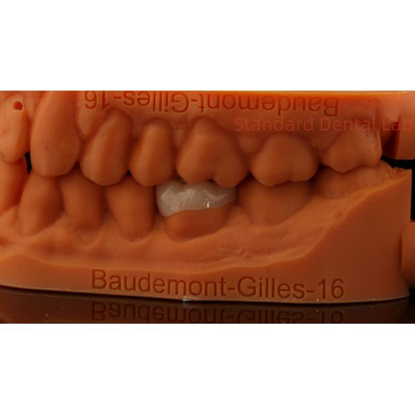 Strength Emax Ceramic Crown Dental Onlay with Excellent Stain Resistance China Dental Lab