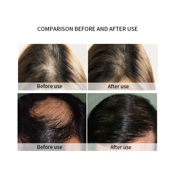 Волосы личной власти растут лазер чистят электрический гребень щеткой для обработки выпадения волос