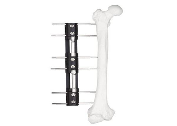 Medical External Fixator of bone lengthening, light and easy to do the operation