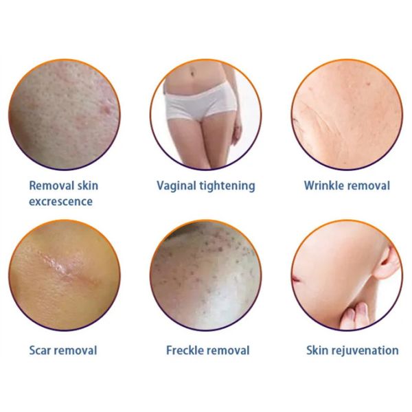 Портативная частичная красота удаления угорь шрама машины лазера СО2 10600nm