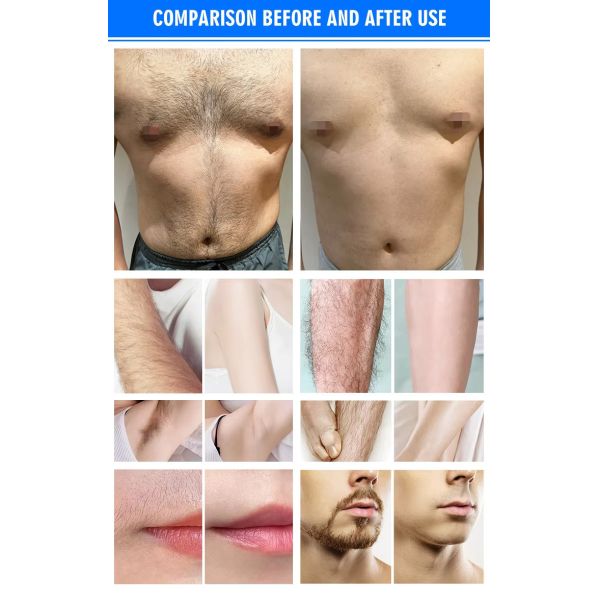 755nm 808nm 1064nm Hair Removal Laser Machine 600W Permanent Hair Removal Device