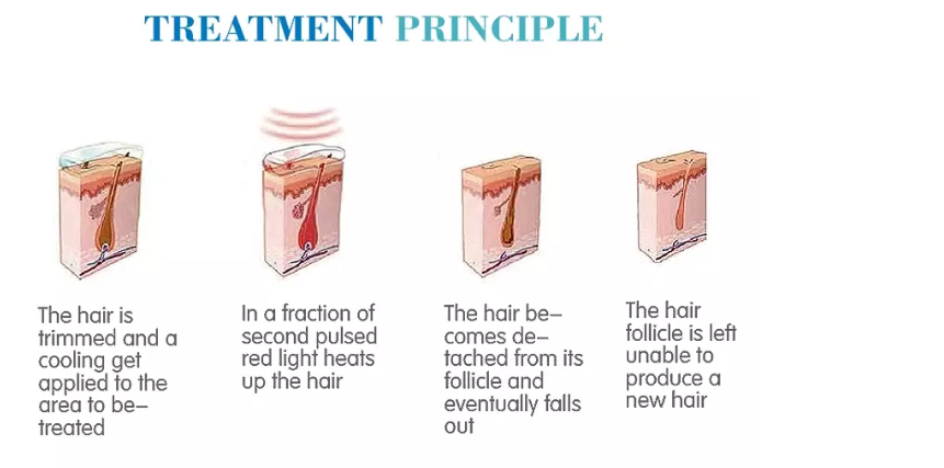 Top 2019 European popular professional aesthetic spa equipment diode laser hair removal machine for sale