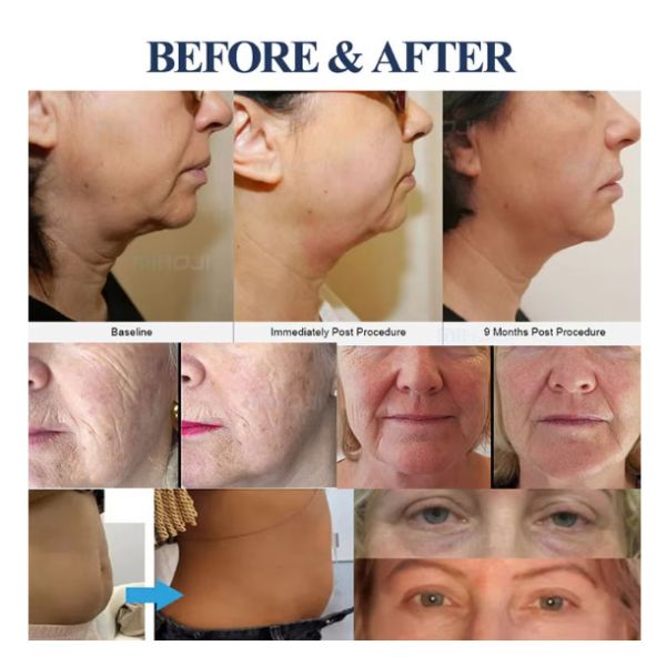 Портативный 2 в 1 13d Max Dual System Hifu Machine для антивозрастного увлажнения детей