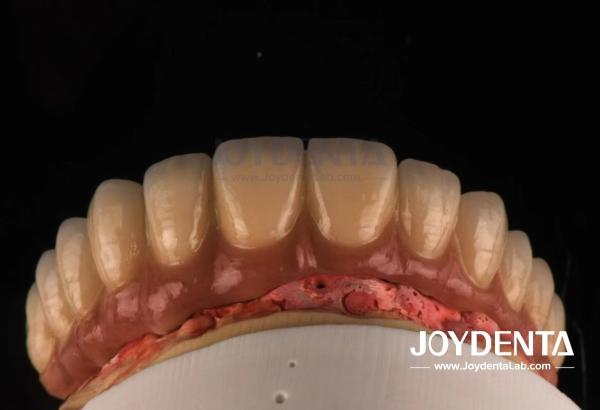 Casting And Milling PFM Tooth Crown , Dental Restorations Porcelain Fused Metal Crown