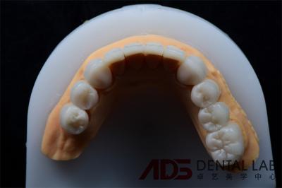High Stain Resistance Dental Emax Ceramic Veneers Crown For Teeth 400MPa