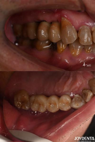Rough Surface Design Dental Implant for Subcrestal Bone Level Titanium Material