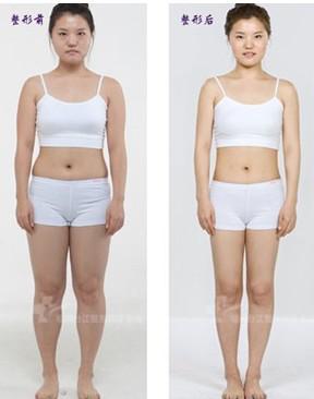 New design Lipo laser slimming