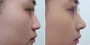 Skinject увеличение губы дермального заполнителя 2 ML Hyaluronic кисловочное лицевое заполняя