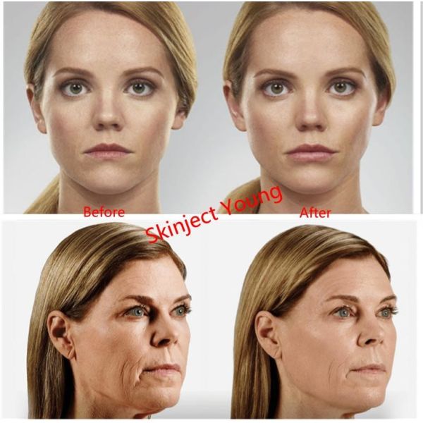 Juvederm Гиалуроновая кислота для личного наполнения кожи для инъекций для наполнения губ
