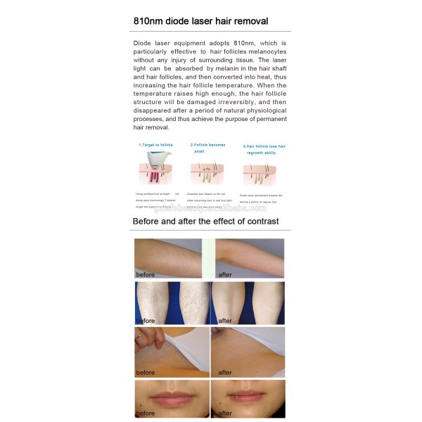 Portable CE approved 808nm laser medical machine diode hair removal laser machine price