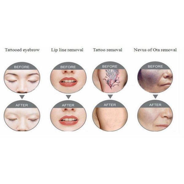 Beauty Salon Use Nd Yag Laser Tattoo Removal Machine for Eyebrow Removal