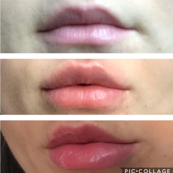 Впрыска Juvederm 2x1ml заполнитель 24mg/Ml ультра 3 губ дермальный