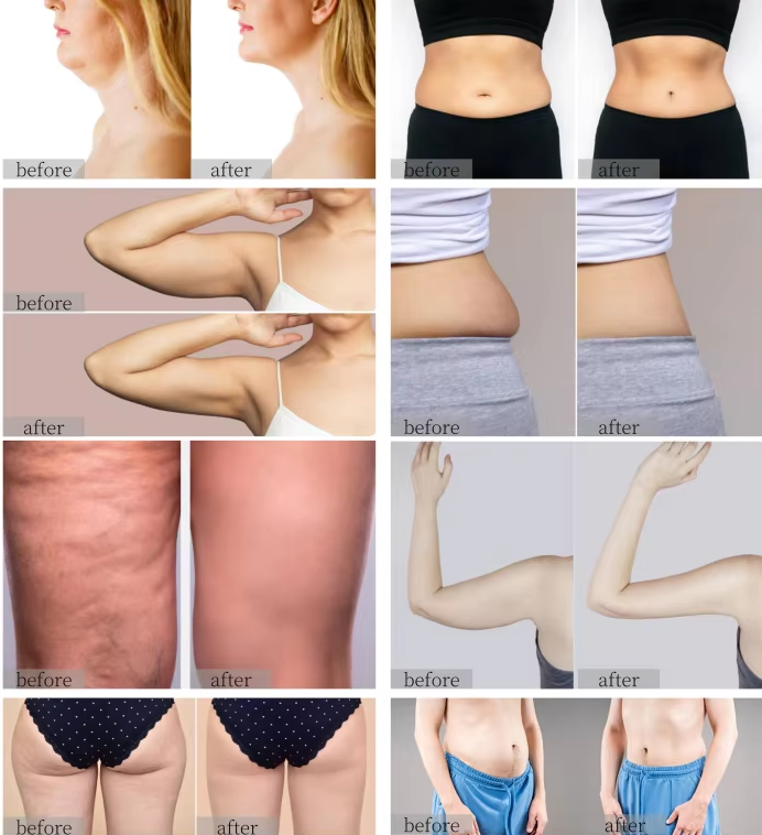Wrinkle Removal Anti Cellulite 40K Cavitation Rf Vacumm Roller 360 Rotating Velashaping Slimming Machine