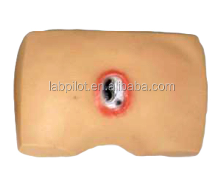 Decubitus Illness Evolution Models for Hospitals Streamlining Pressure Ulcers Nursing