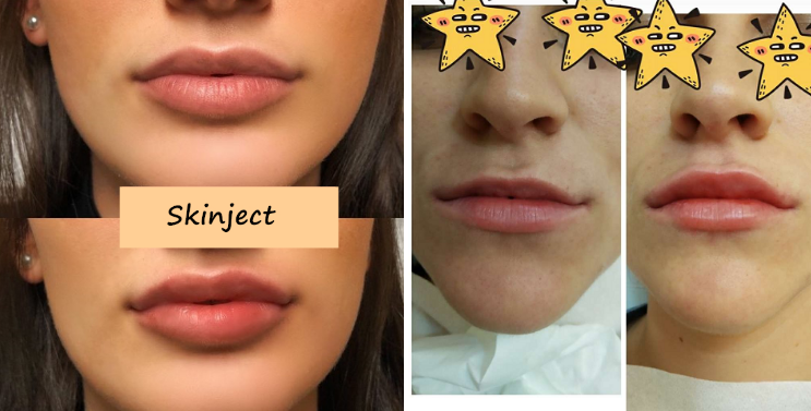 Впрыска Juvederm 2x1ml заполнитель 24mg/Ml ультра 3 губ дермальный